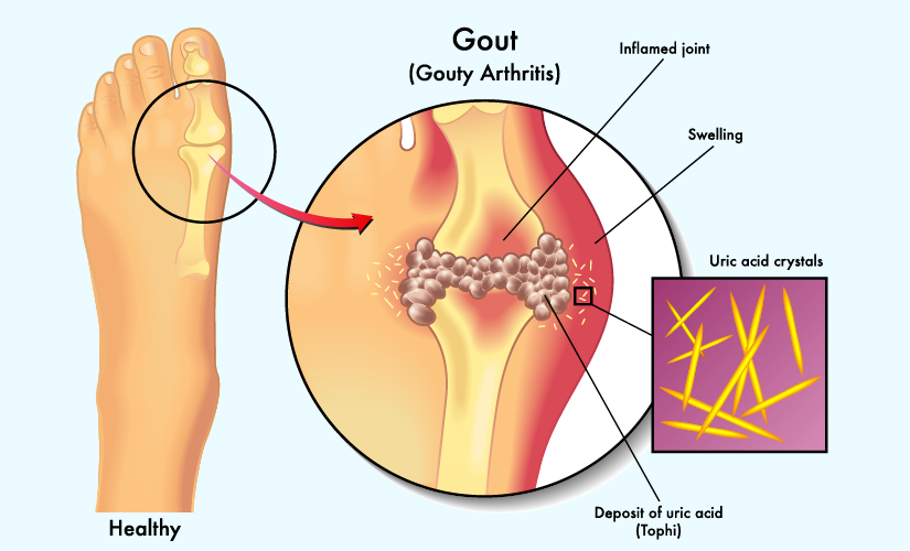 Uric Acid