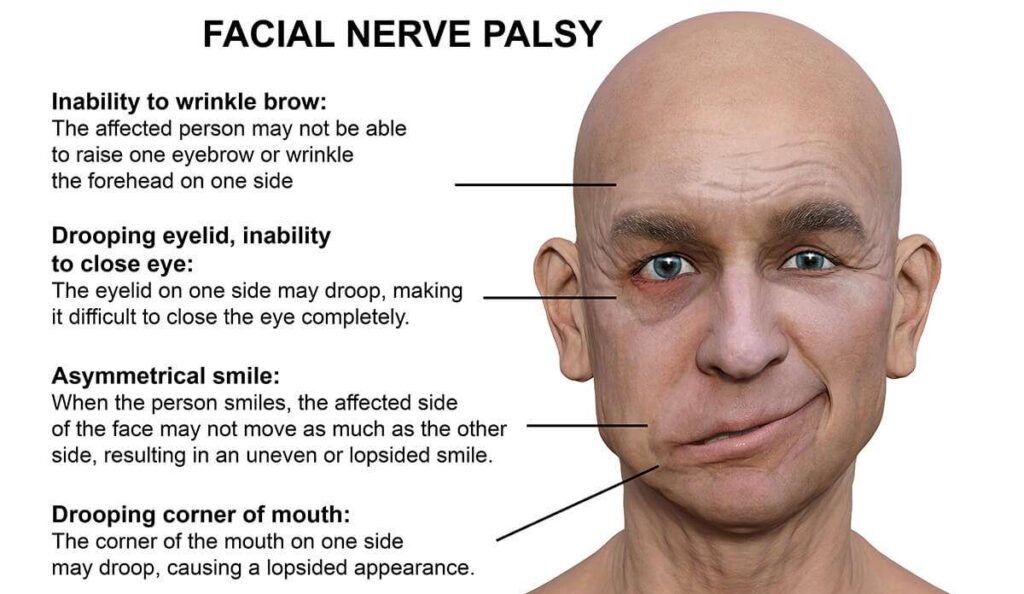 bells-palsy