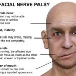 bells-palsy